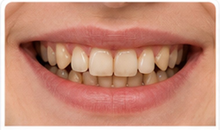 Crooked Teeth dental problem