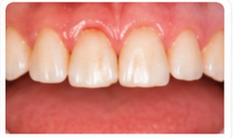 Gum Disease dental problem