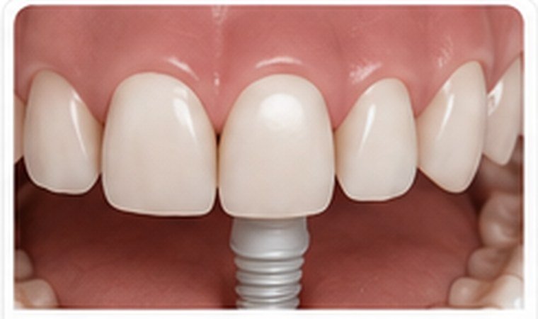 Missing Teeth dental problem
