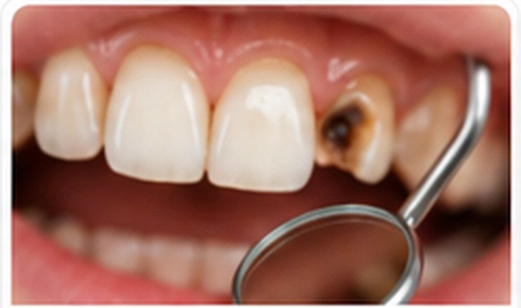 Tooth Decay dental problem