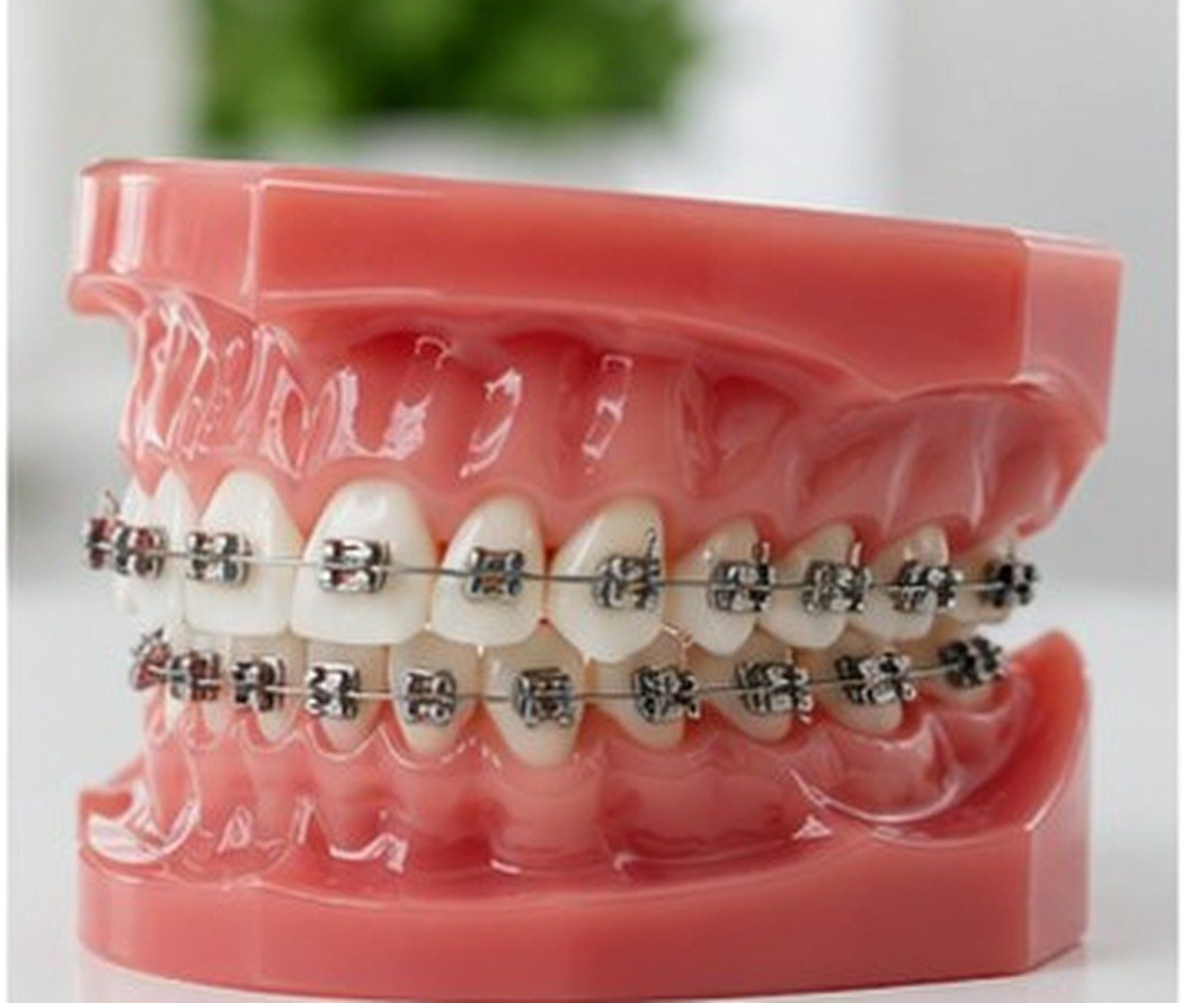 Braces Pune dental care at Amayra Polyclinic & Dental Hub