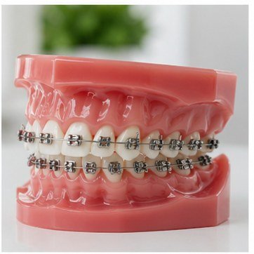 Orthodontic braces treatment