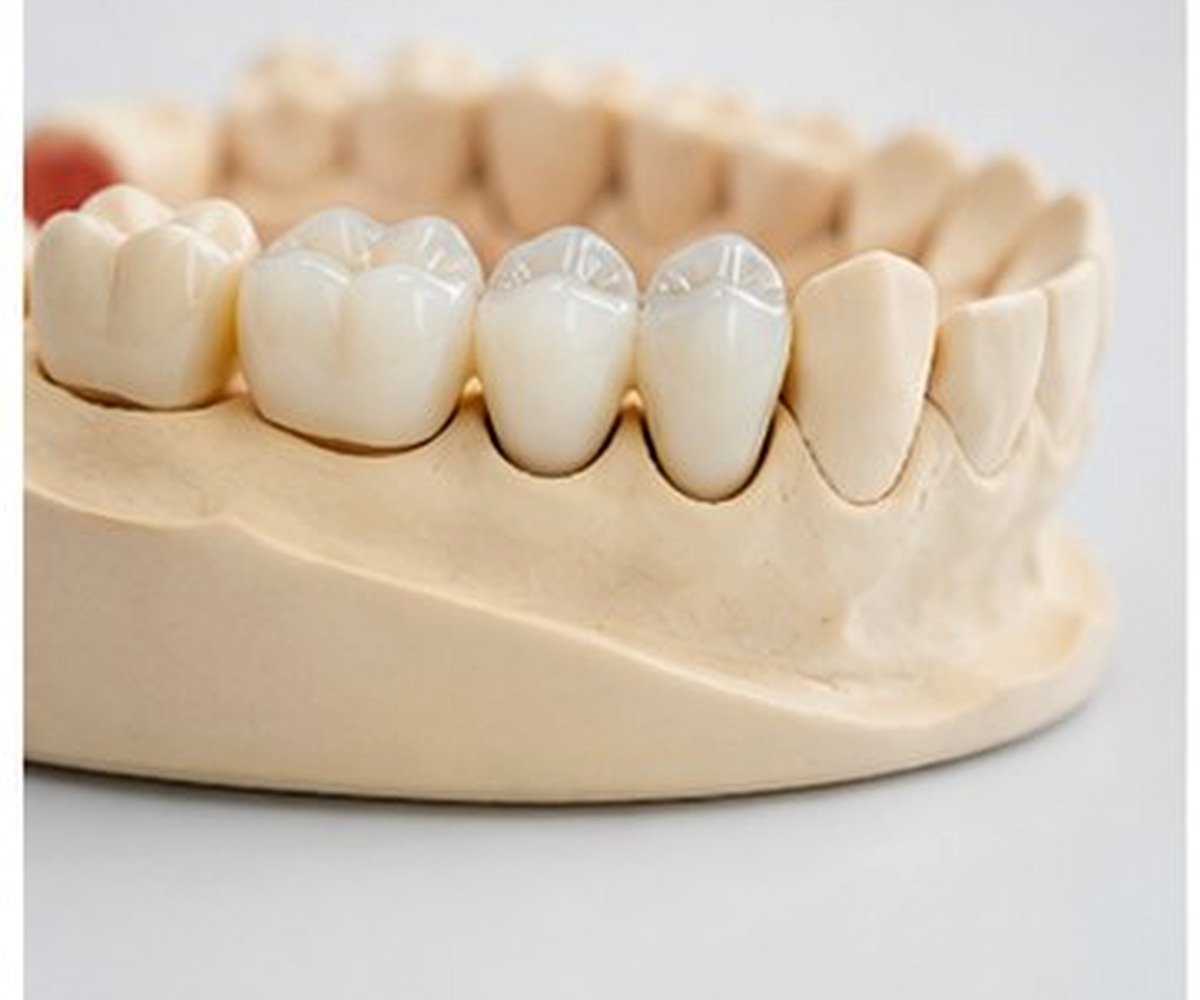 Dental Crown Cost Pune dental care at Amayra Polyclinic & Dental Hub