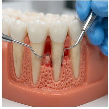Gum treatment and periodontal care